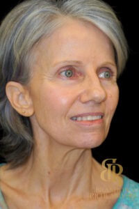 Facelift & Neck Lift before and after, Patient 10 — Dr. Brandon Richland, Newport Beach