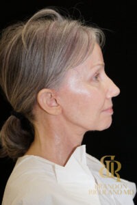Facelift & Neck Lift before and after, Patient 10 — Dr. Brandon Richland, Newport Beach