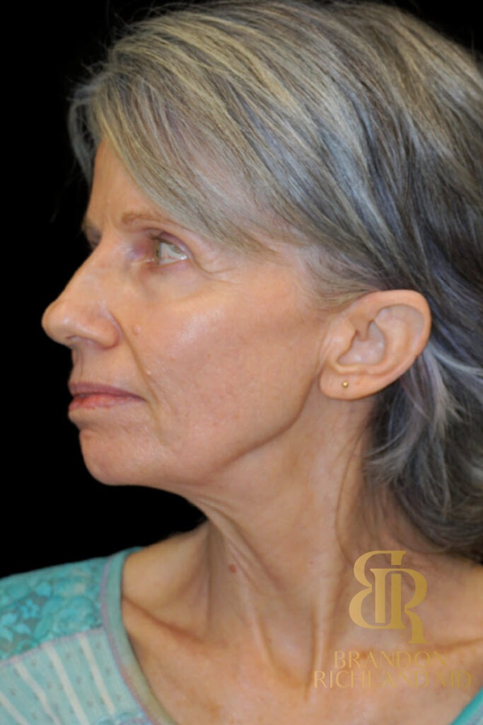 Facelift & Neck Lift Before, Patient 10, view 5 — Dr. Brandon Richland, Newport Beach