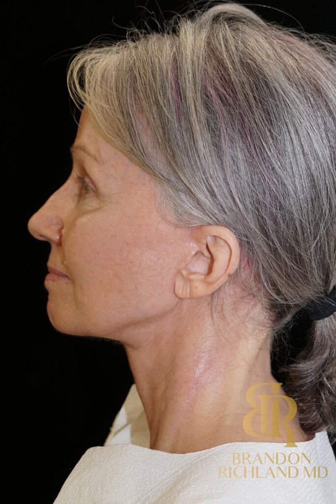 Facelift & Neck Lift After, Patient 10, view 5 — Dr. Brandon Richland, Newport Beach