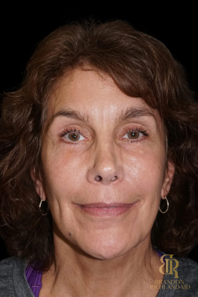 Brow Lift After, Case #26787, view 1 — Dr. Brandon Richland, Newport Beach