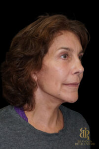 Brow Lift before and after, Case #26787 — Dr. Brandon Richland, Newport Beach