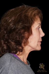 Brow Lift before and after, Case #26787 — Dr. Brandon Richland, Newport Beach