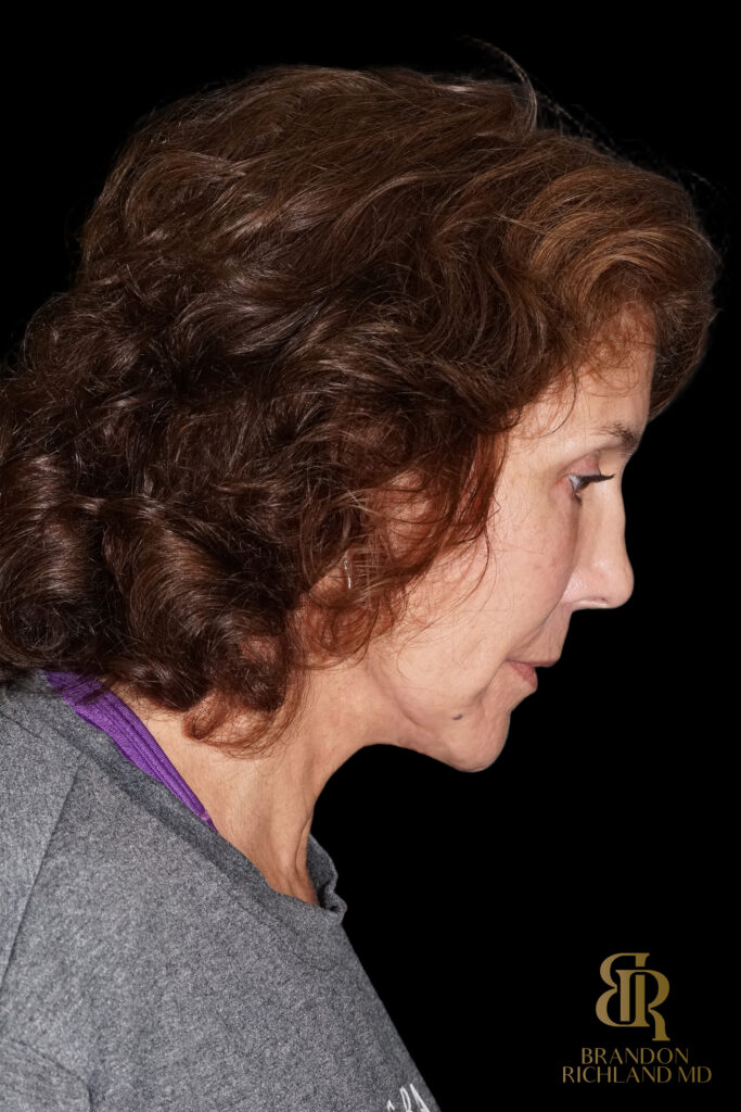 Brow Lift After, Case #26787, view 4 — Dr. Brandon Richland, Newport Beach