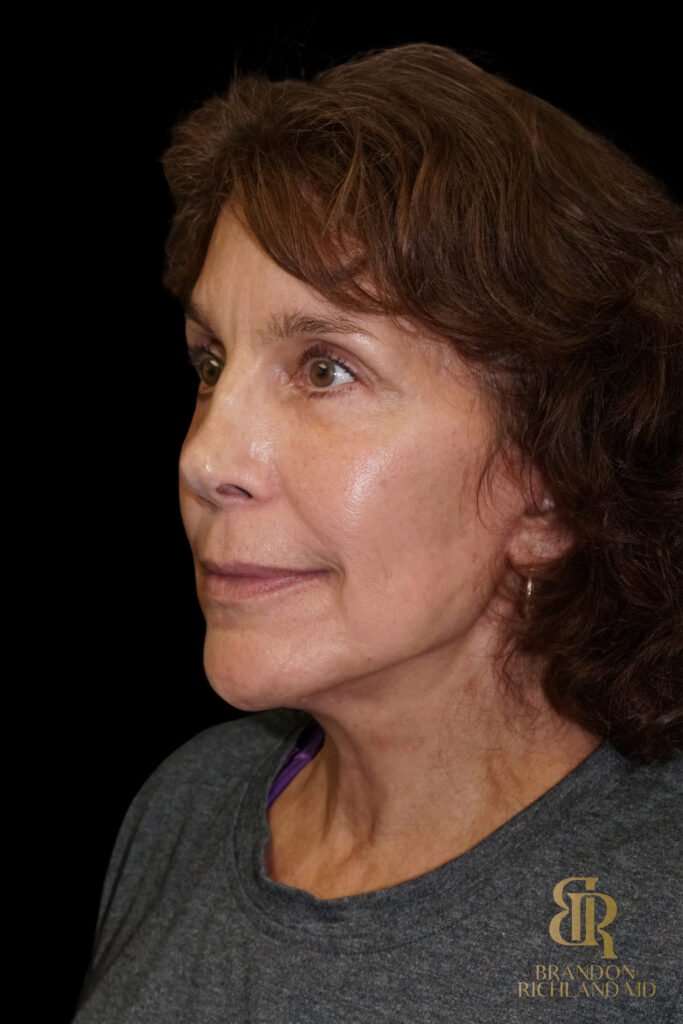 Brow Lift After, Case #26787, view 5 — Dr. Brandon Richland, Newport Beach