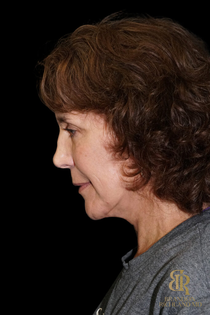 Brow Lift After, Case #26787, view 7 — Dr. Brandon Richland, Newport Beach