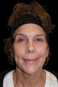 Brow Lift before and after, Case #26787 — Dr. Brandon Richland, Newport Beach