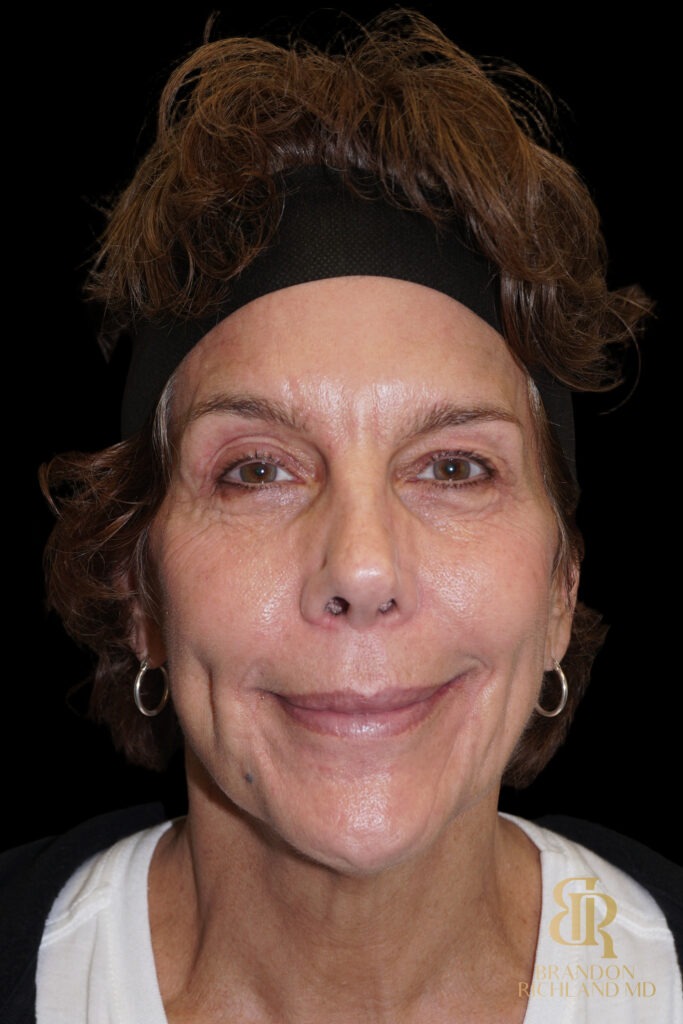 Brow Lift Before, Case #26787, view 1 — Dr. Brandon Richland, Newport Beach