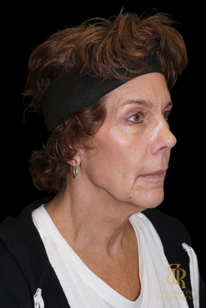 Brow Lift Before, Case #26787, view 2 — Dr. Brandon Richland, Newport Beach