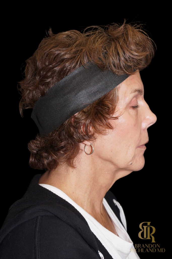 Brow Lift Before, Case #26787, view 3 — Dr. Brandon Richland, Newport Beach