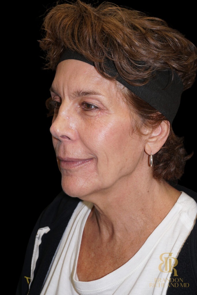 Brow Lift Before, Case #26787, view 5 — Dr. Brandon Richland, Newport Beach