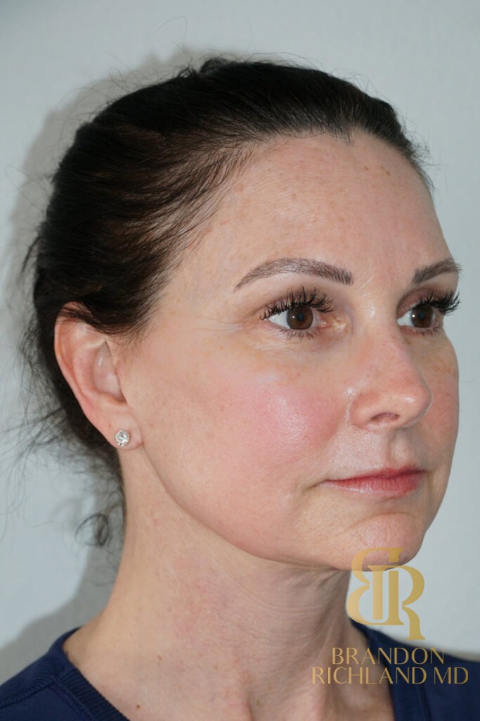 Facelift After, Patient 02, view 2 — Dr. Brandon Richland, Newport Beach