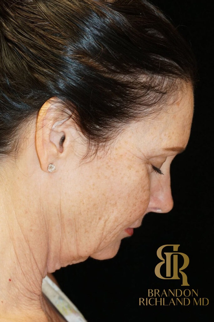 Facelift Before, Patient 02, view 4 — Dr. Brandon Richland, Newport Beach