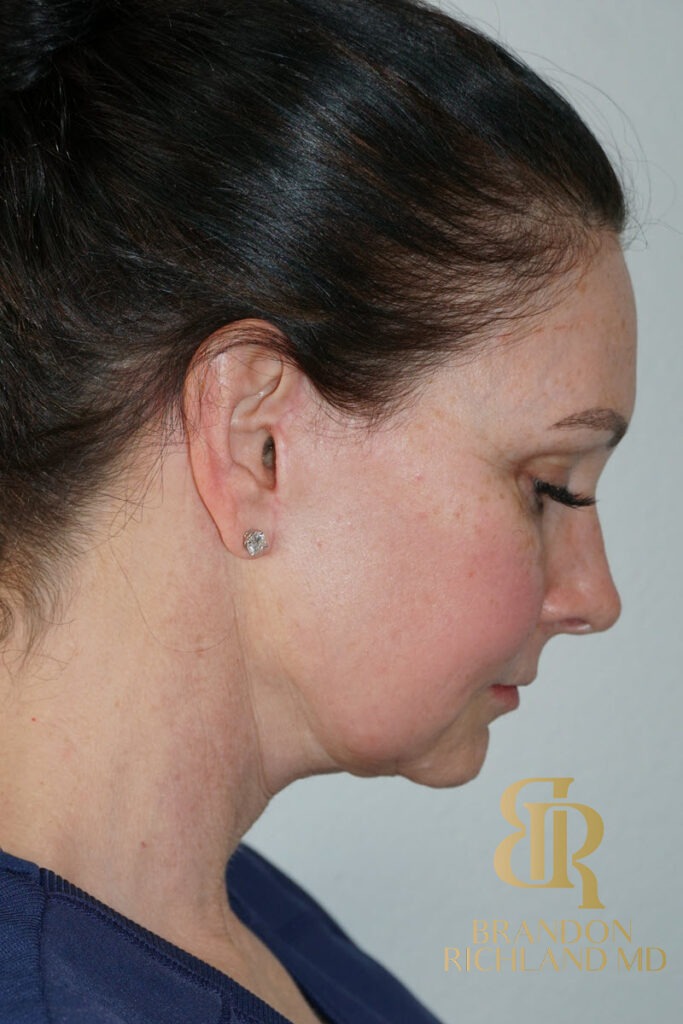 Facelift After, Patient 02, view 4 — Dr. Brandon Richland, Newport Beach