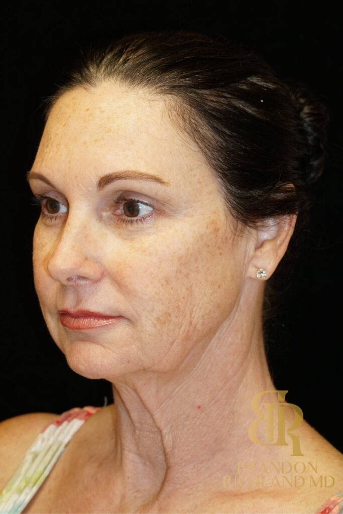 Facelift Before, Patient 02, view 5 — Dr. Brandon Richland, Newport Beach