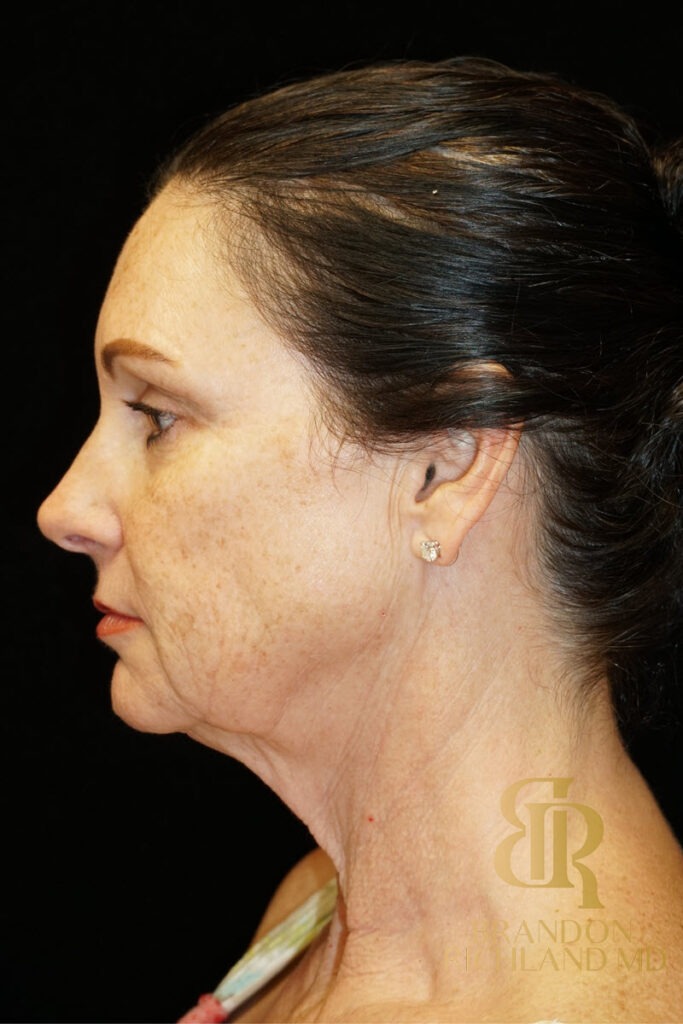 Facelift Before, Patient 02, view 6 — Dr. Brandon Richland, Newport Beach