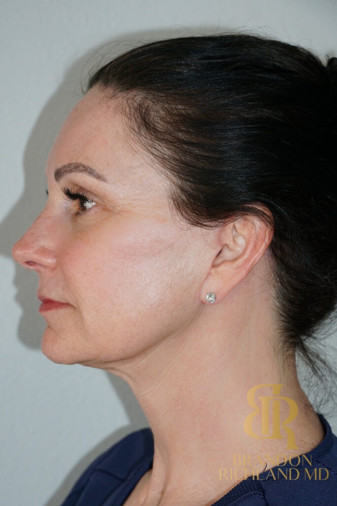 Facelift After, Patient 02, view 6 — Dr. Brandon Richland, Newport Beach