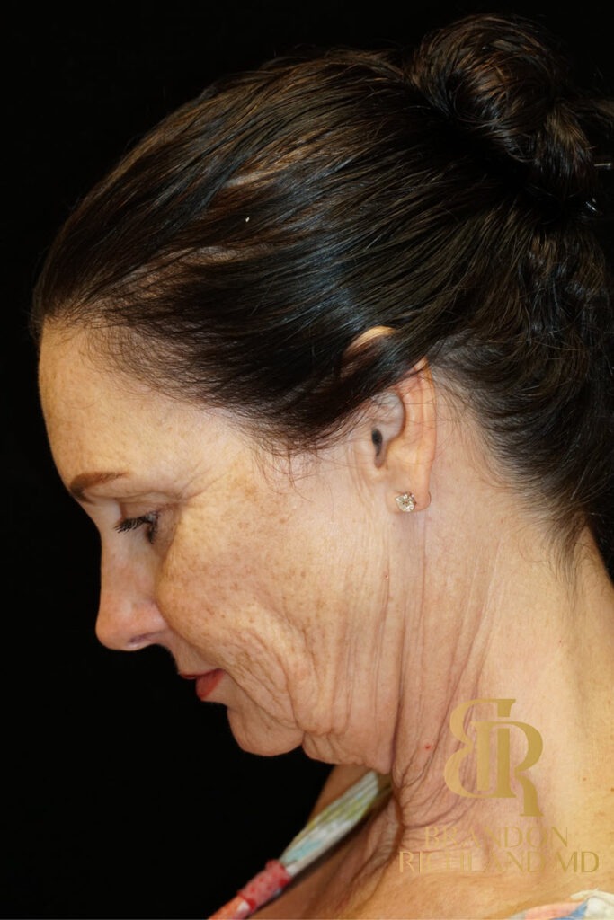 Facelift Before, Patient 02, view 7 — Dr. Brandon Richland, Newport Beach