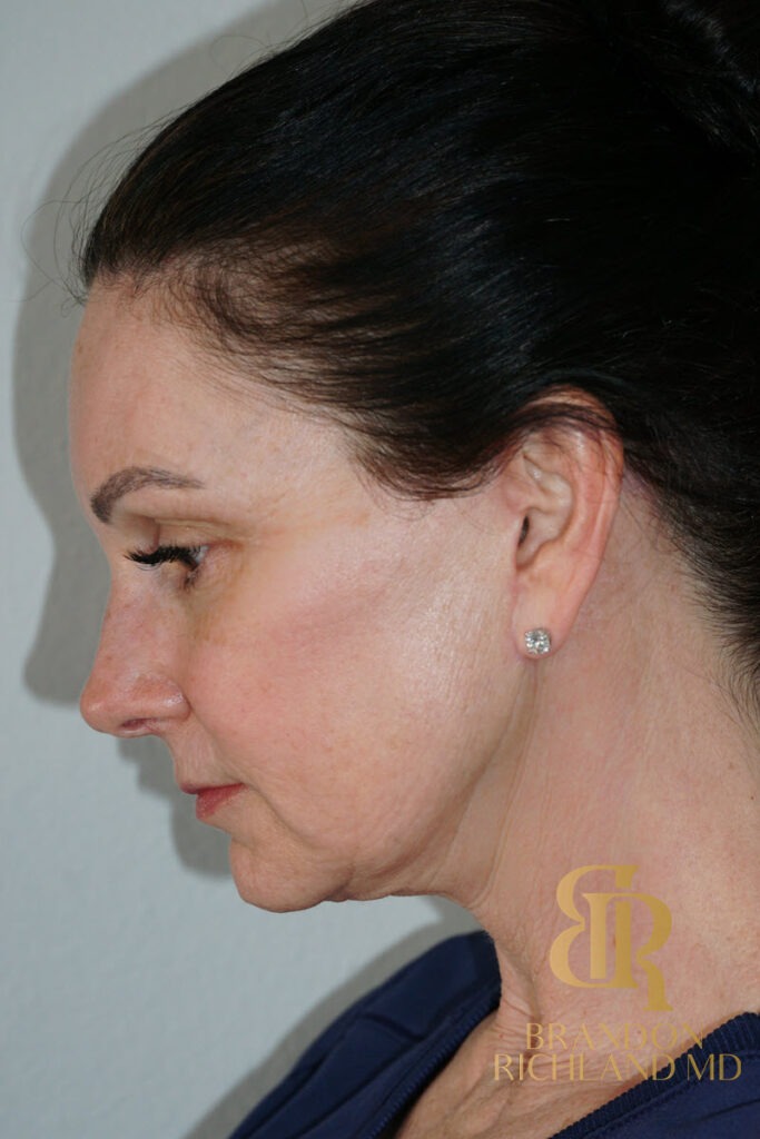 Facelift After, Patient 02, view 7 — Dr. Brandon Richland, Newport Beach