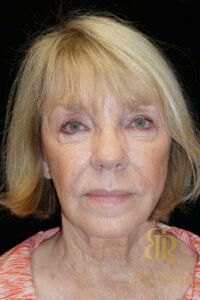 Facelift before and after, Patient 03 — Dr. Brandon Richland, Newport Beach