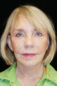 Facelift before and after, Patient 03 — Dr. Brandon Richland, Newport Beach