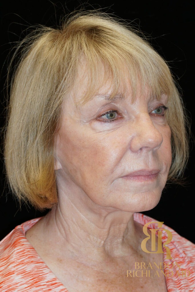 Facelift Before, Patient 03, view 2 — Dr. Brandon Richland, Newport Beach