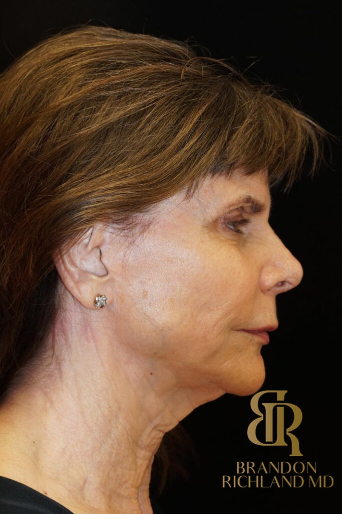 Facelift Before, Patient 05, view 3 — Dr. Brandon Richland, Newport Beach