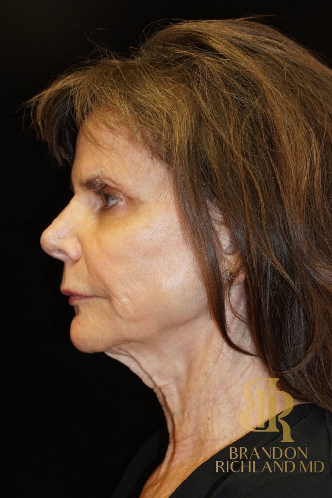 Facelift Before, Patient 05, view 6 — Dr. Brandon Richland, Newport Beach