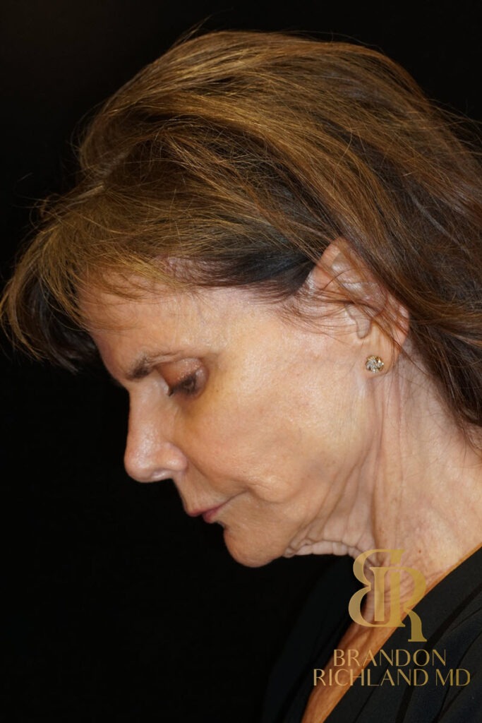 Facelift Before, Patient 05, view 7 — Dr. Brandon Richland, Newport Beach