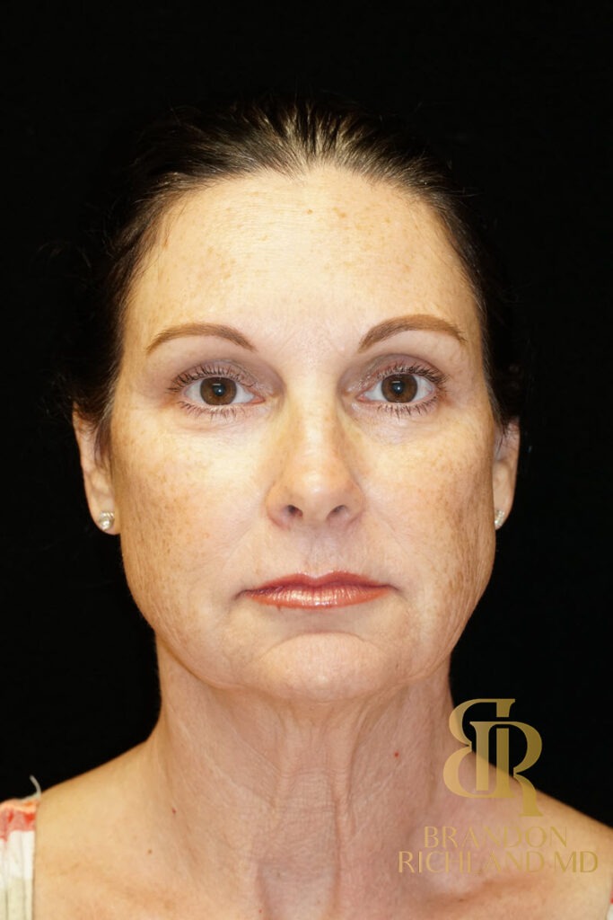 Facial Fat Transfer Before, Patient 02, view 1 — Dr. Brandon Richland, Newport Beach