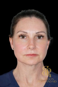 Facial Fat Transfer before and after, Patient 02 — Dr. Brandon Richland, Newport Beach
