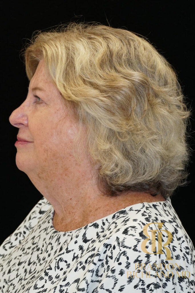 Facial Fat Transfer Before, Patient 06, view 4 — Dr. Brandon Richland, Newport Beach