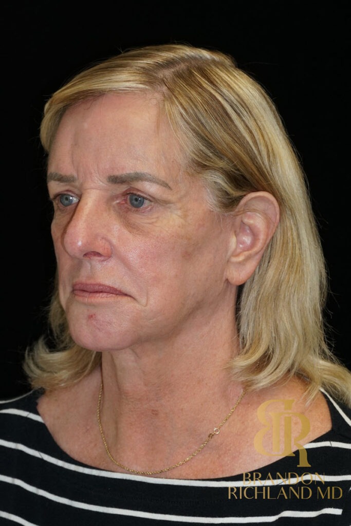 Facial Fat Transfer Before, Patient 07, view 4 — Dr. Brandon Richland, Newport Beach