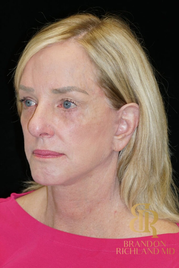 Facial Fat Transfer After, Patient 07, view 4 — Dr. Brandon Richland, Newport Beach