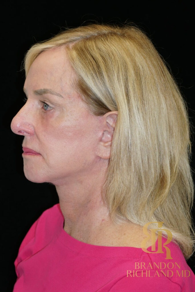 Facial Fat Transfer After, Patient 07, view 5 — Dr. Brandon Richland, Newport Beach