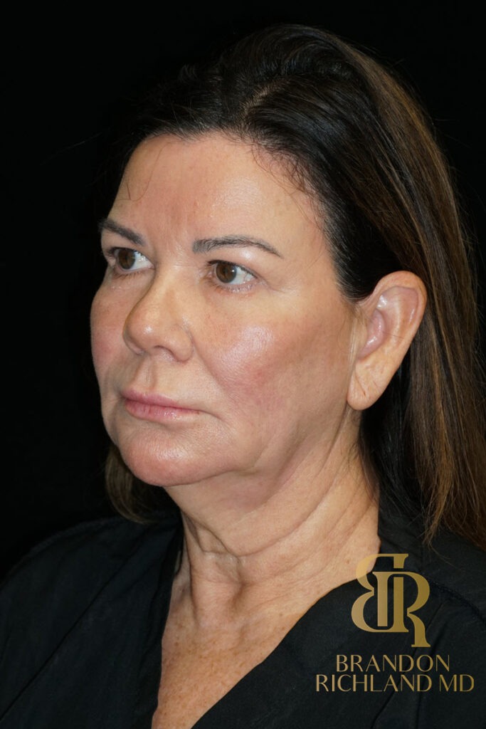 Facial Fat Transfer Before, Patient 08, view 4 — Dr. Brandon Richland, Newport Beach