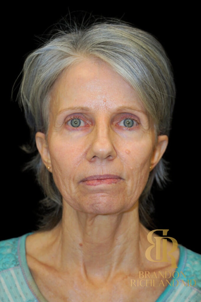 Facial Fat Transfer Before, Patient 09, view 1 — Dr. Brandon Richland, Newport Beach