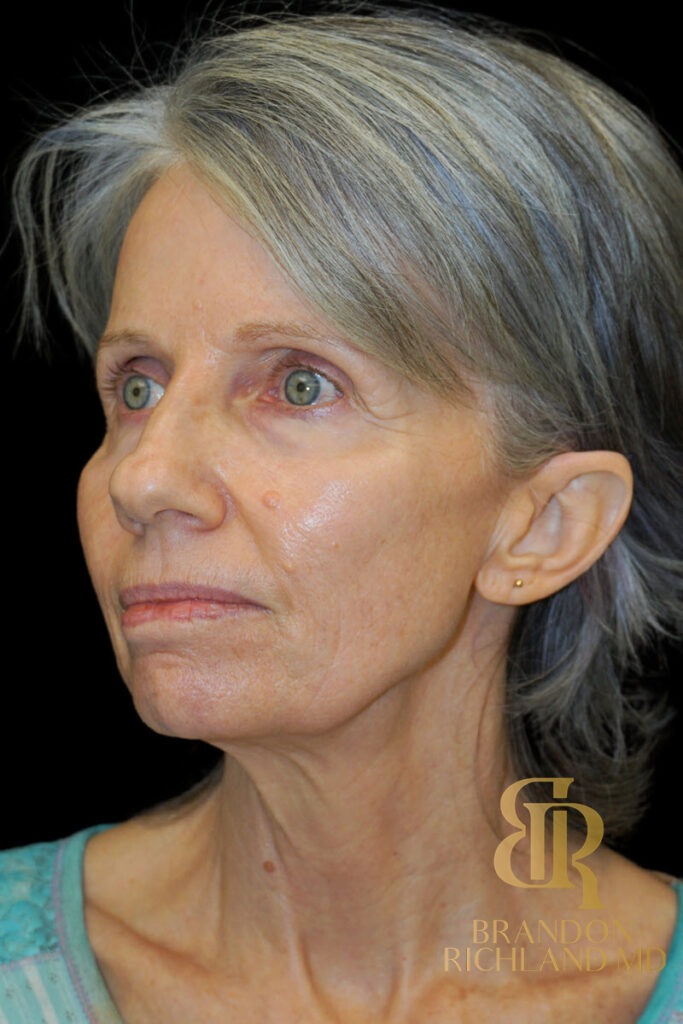 Facial Fat Transfer Before, Patient 09, view 4 — Dr. Brandon Richland, Newport Beach