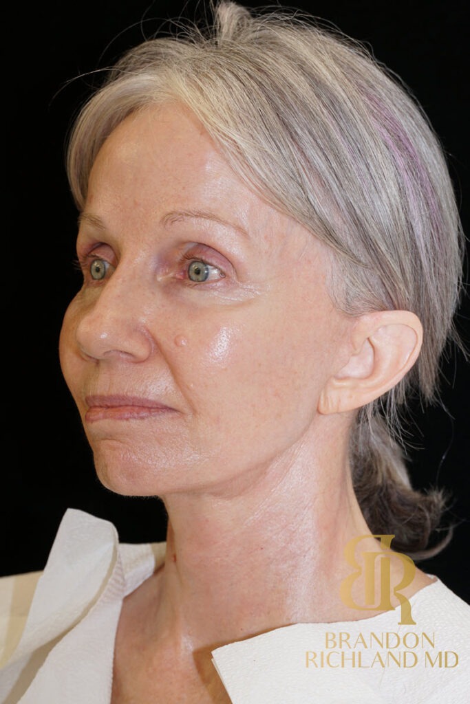 Facial Fat Transfer After, Patient 09, view 4 — Dr. Brandon Richland, Newport Beach