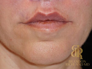 Lip Lift before and after, Patient 01 — Dr. Brandon Richland, Newport Beach