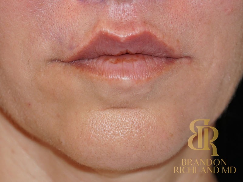 Lip Lift Before, Patient 01, view 1 — Dr. Brandon Richland, Newport Beach