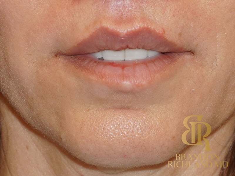 Lip Lift After, Patient 01, view 1 — Dr. Brandon Richland, Newport Beach