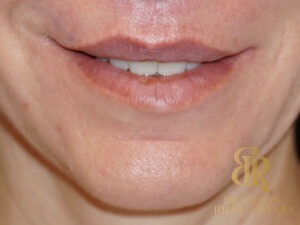 Lip Lift before and after, Patient 01 — Dr. Brandon Richland, Newport Beach