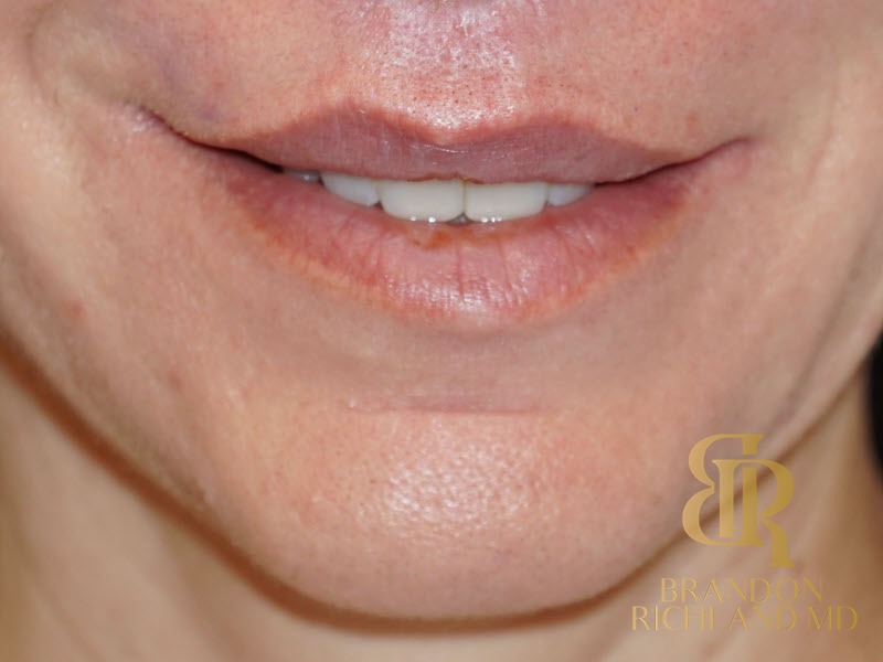 Lip Lift Before, Patient 01, view 2 — Dr. Brandon Richland, Newport Beach