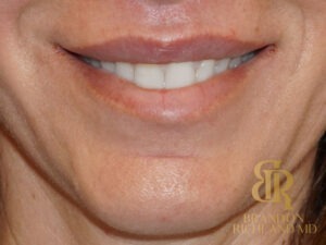 Lip Lift before and after, Patient 01 — Dr. Brandon Richland, Newport Beach