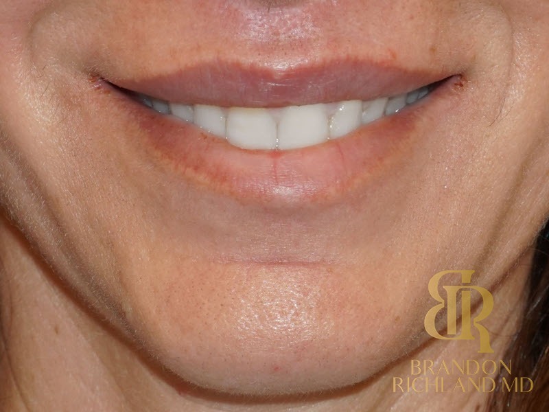 Lip Lift After, Patient 01, view 2 — Dr. Brandon Richland, Newport Beach