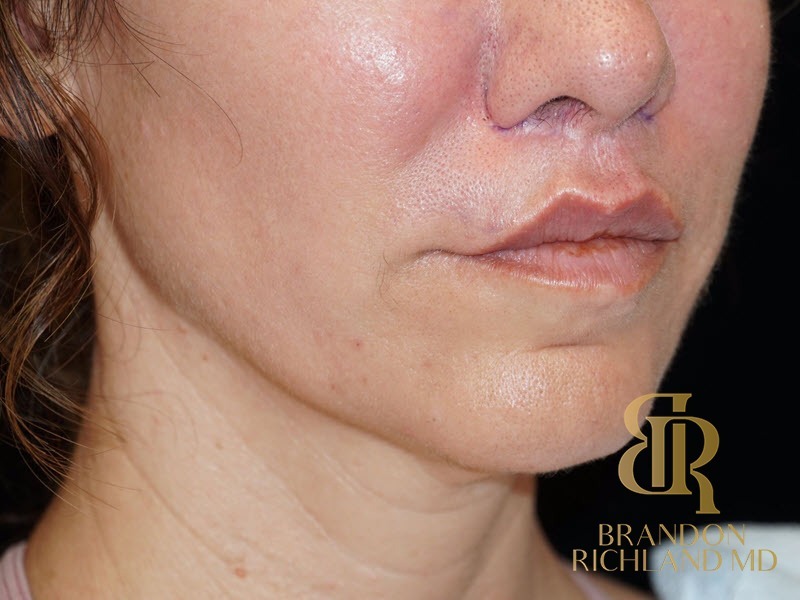Lip Lift Before, Patient 01, view 3 — Dr. Brandon Richland, Newport Beach