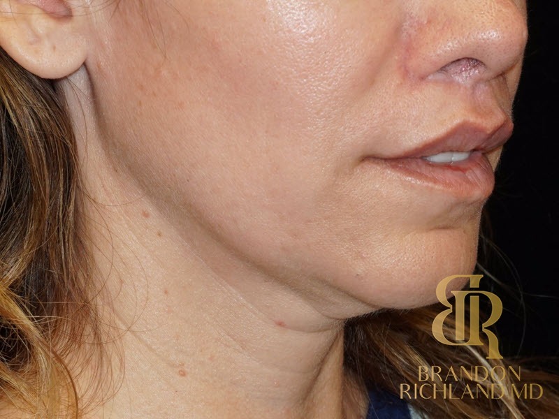 Lip Lift After, Patient 01, view 3 — Dr. Brandon Richland, Newport Beach