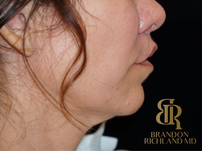 Lip Lift Before, Patient 01, view 4 — Dr. Brandon Richland, Newport Beach