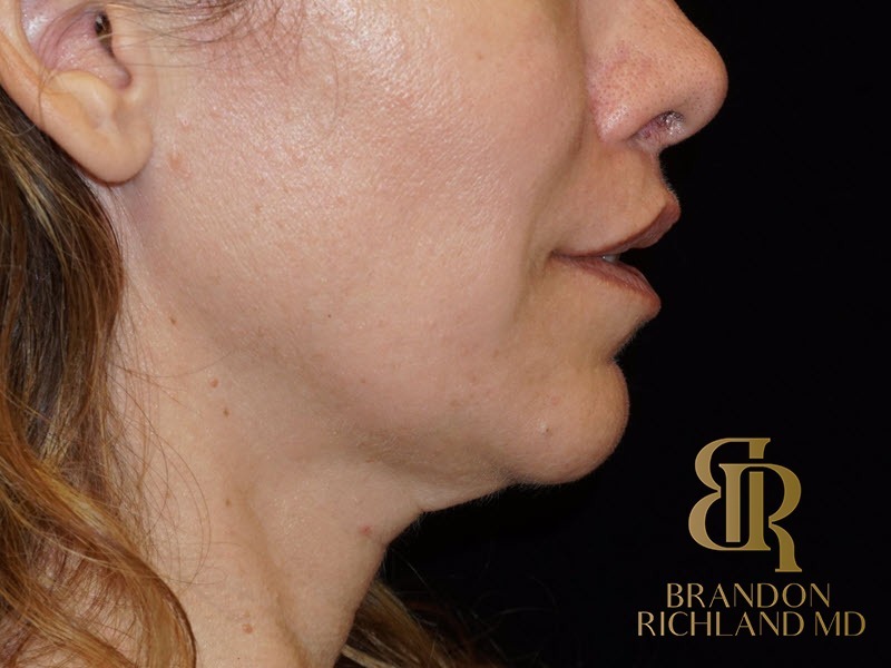 Lip Lift After, Patient 01, view 4 — Dr. Brandon Richland, Newport Beach